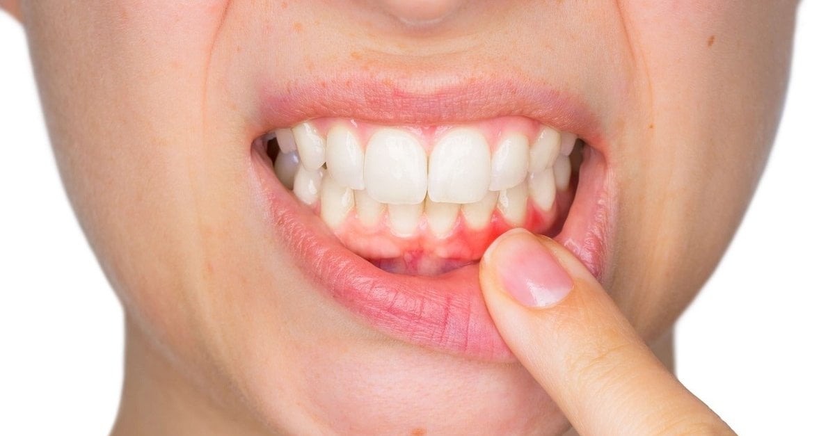 Diş Eti İltihabı ve Tedavi Yöntemleri