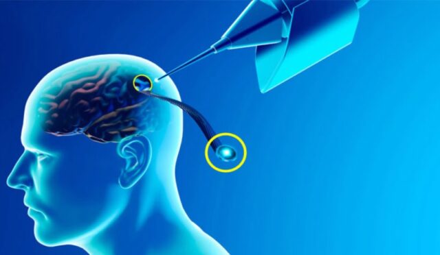 neurolink-nedir-elon-musk
