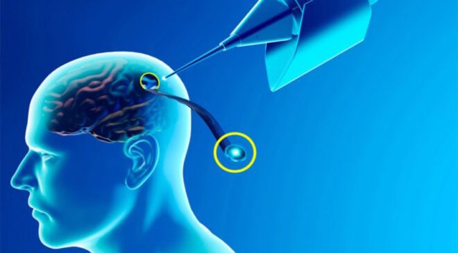 neurolink-nedir-elon-musk