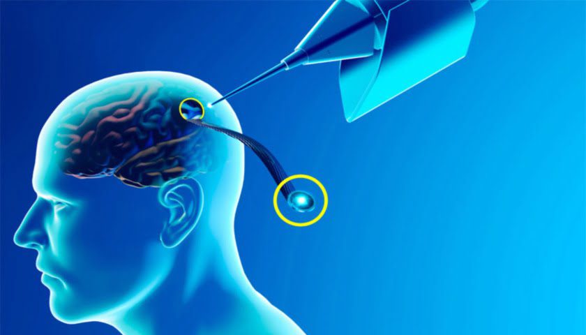 Neuralink Çip Nedir? Ne İşe Yarar? Nasıl Çalışır?