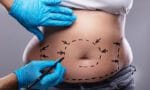 Liposuction nedir