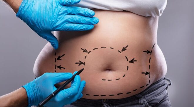 Liposuction nedir