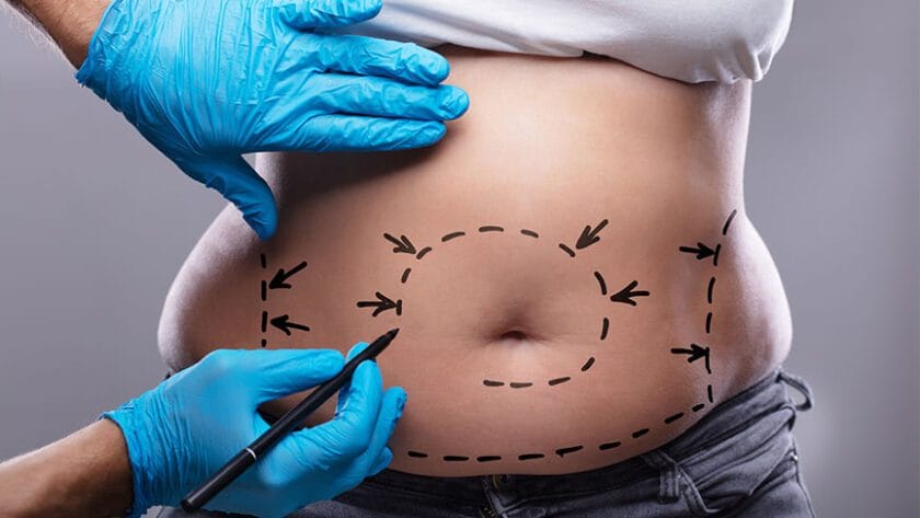 Liposuction nedir