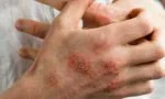 egzama nedir belirtileri nelerdir