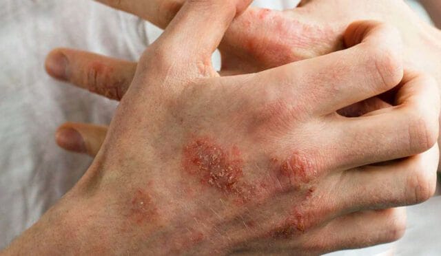 egzama nedir belirtileri nelerdir