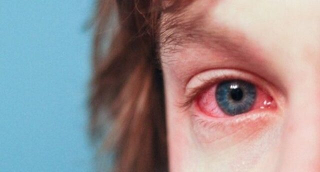 Göz Nezlesi Nedir, Belirtileri Ve Tedavisi Nasıldır