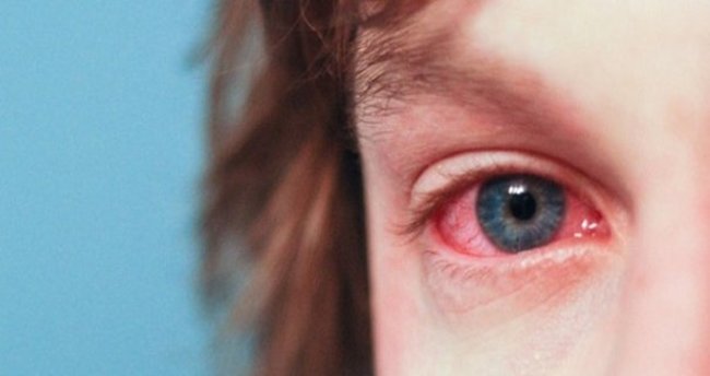Göz Nezlesi Nedir, Belirtileri Ve Tedavisi Nasıldır
